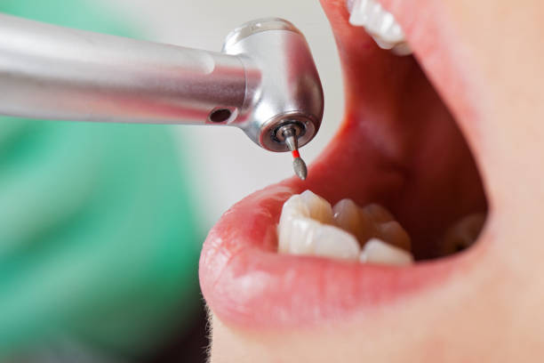 Best Broken or Cracked Tooth Emergency Dentist in Pierce City, MO
